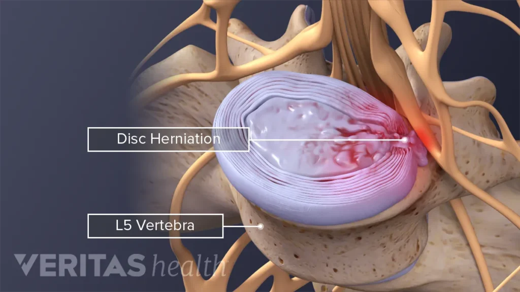 ernia del disco - sciatica