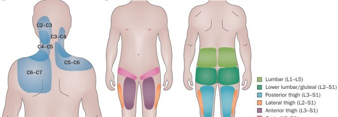 sindrome delle faccette articolari - distribuzione del dolore