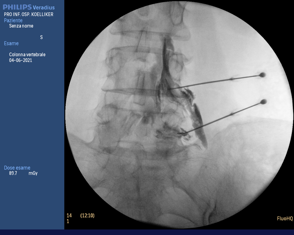 Sciatica e radiofrequenza